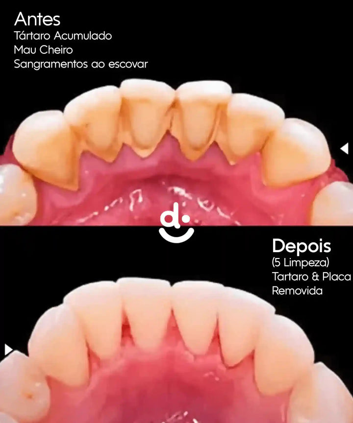 HidroJet Pro – Irrigador Oral de Limpeza Profunda